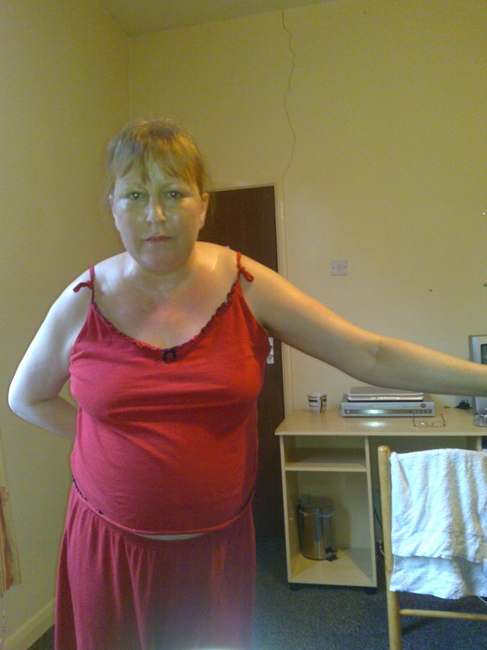 This is me, just out of hospital August 2010 - I hate this photo - This is what alcohol did to me...