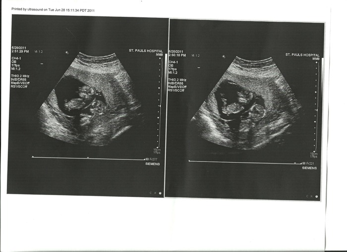 Second surrogacy,twins again. 12 weeks 2 days. June 28th 2011  