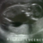 baby at NT Scan measured 14 weeks 6 days