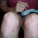Fluid pockets all over knees
