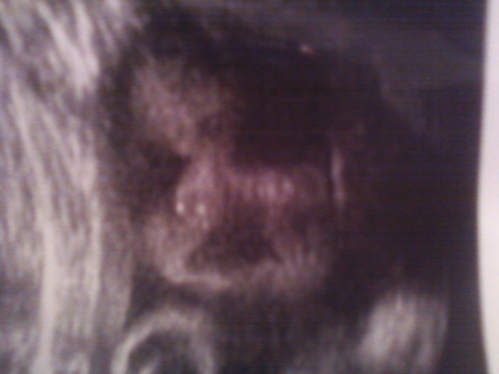 Christian 32week Ultrasound! Chubby cheeks and yes he keeps his hand under his chin still!