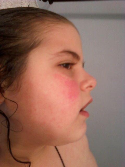 Is this Systematic Lupus Erythematous? 5th disease?