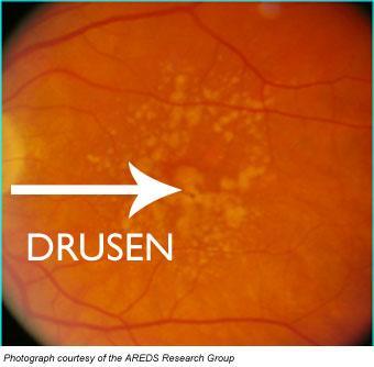 soft macular drusen are one type of dry macular degeneration