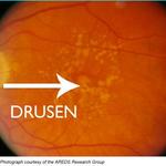 soft macular drusen are one type of dry macular degeneration