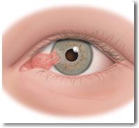 Pterygium: usually due to sun damage