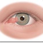 Pterygium: usually due to sun damage