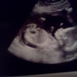 Baby Aubrey at 20 weeks