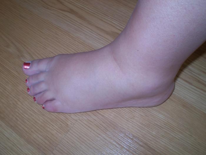 Sexy, swollen ankles at 23 1/2 weeks (Shrek feet as I call them)