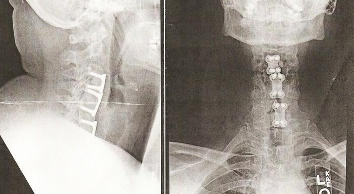 Anterior Cervical Discectomy and Fusion with Plates and Screws 