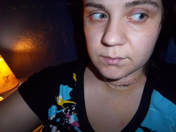 Before:  I like to call this pic Frankenstein.  Bulging eyes, blotchy skin, horrible neck.  
