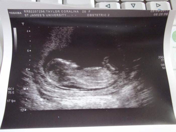 Scan at 13 weeks 1 day :) x