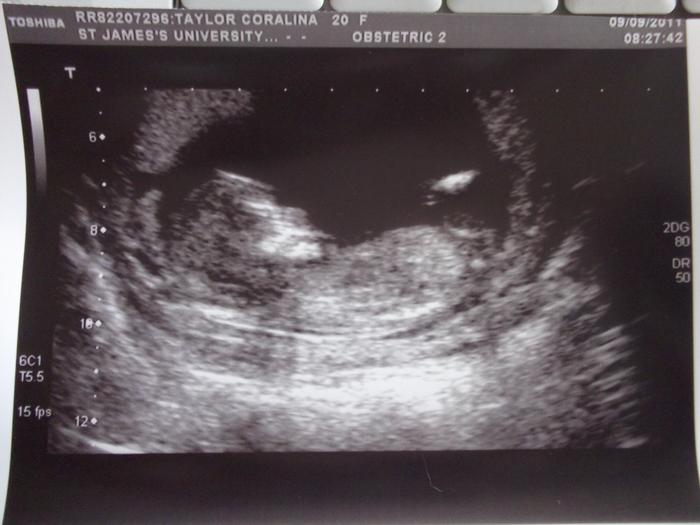 Scan at 13 weeks 1 day :) x