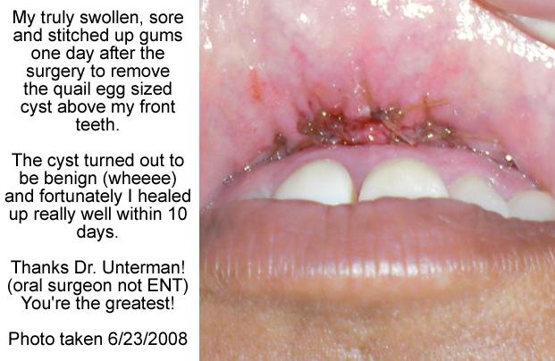 6/23/2008 - Day After Oral Surgery - Ouchie