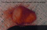 The extracted cyst - About the size of a quail egg