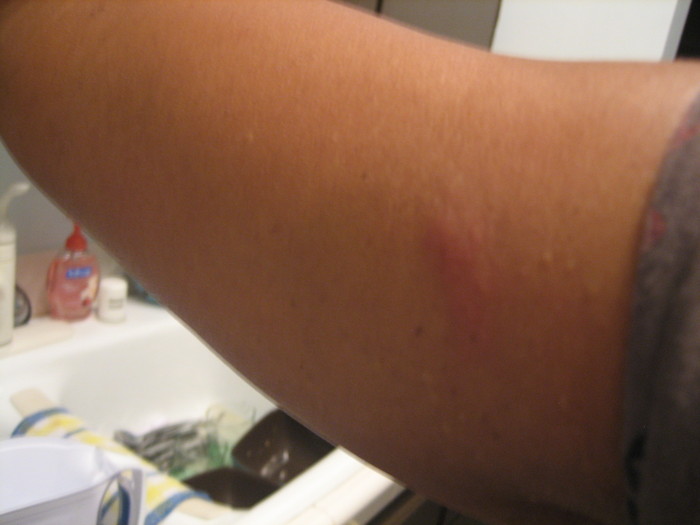 RIBA rash, inside upper arm, Sept 2011