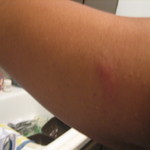 RIBA rash, inside upper arm, Sept 2011