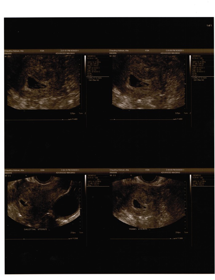 7 Week Ultrasound