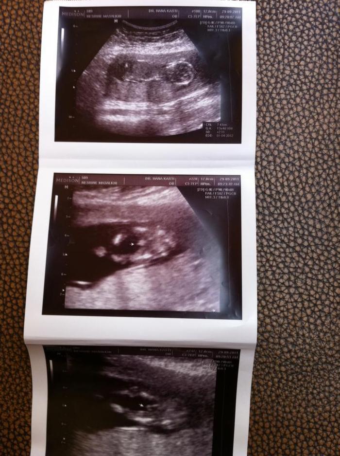 13 weeks 4 days it's a boy !
