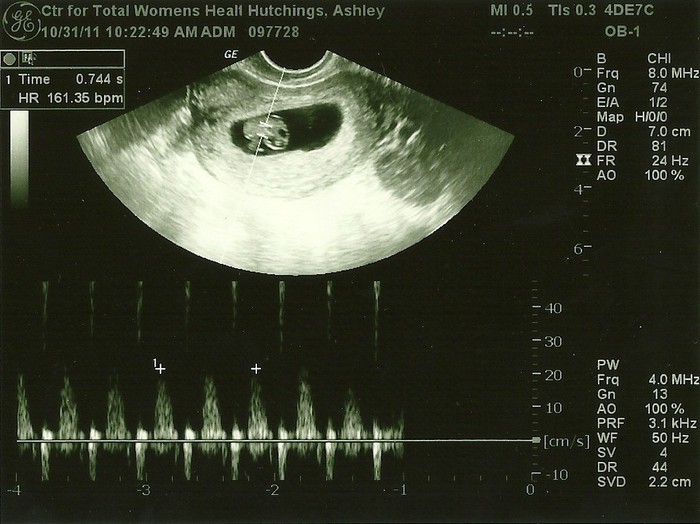 161bpm. This is our little miracle!