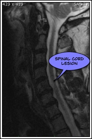 MS lesion on the spine cord just above the C5 disk