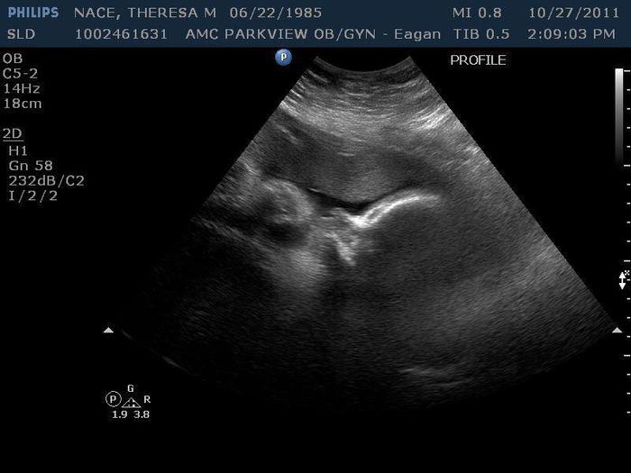32 week profile with hand in mouth
