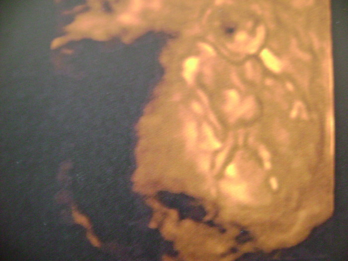 12 weeks 4d scan baby spread apart legs wide open