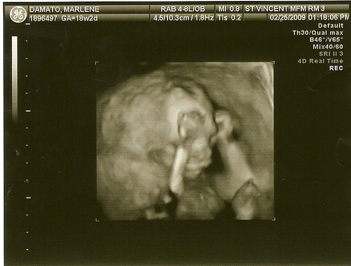 My ultrasound of my son (he is now 2yo)