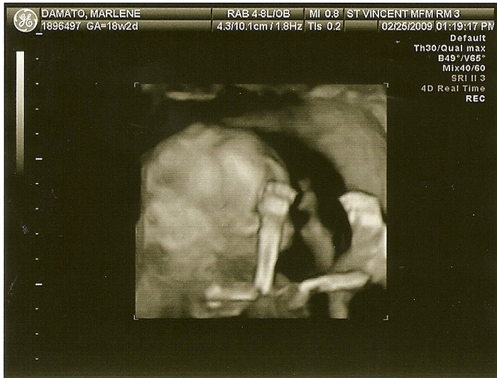 My ultrasound of my son (he is now 2yo) Placenta is covering most of his head