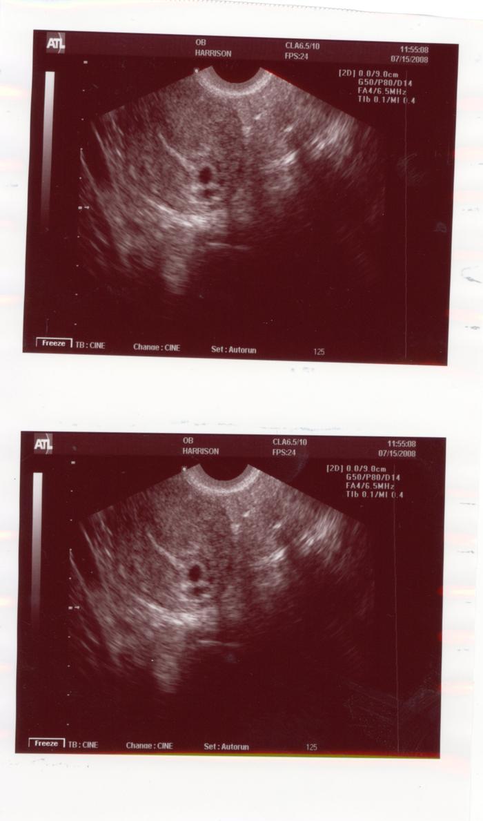 6 week Ultrasound, twins!