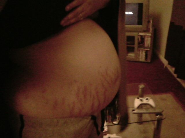 My belly FULL of lovely red stretch marks! Looks like Fire!! lol