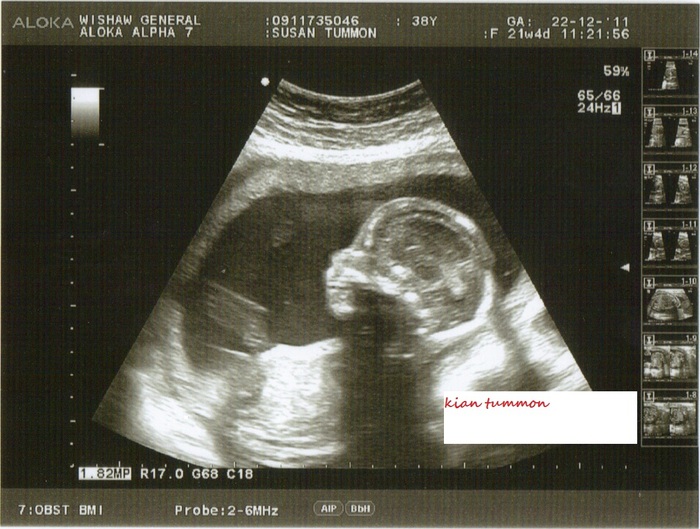 22 week scan . my baby kian 
