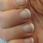 half-and-half nails: distal redness of nail bed (right hand)