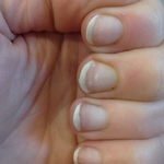 half-and-half nails: distal redness of nail bed (left hand)