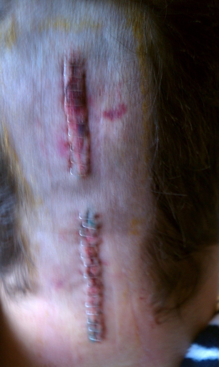 26 staples 2 days post opnwhen bandage was removed