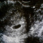 U/S at 5w6d that little white thing was what was pulsing fingers crossed :))