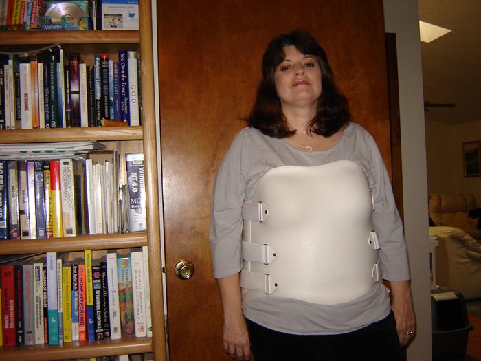 Me, December 2007 with my full-torso back orthosis