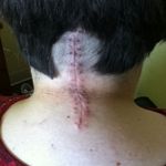 Stitches out 9 days later (finally got to wash my hair. Washed it 3 times, lol) 8/24/11