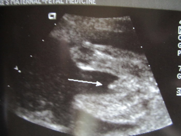 It's a Boy!!--18 weeks