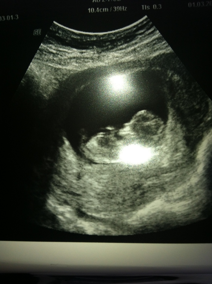 Baby Anderson number 2