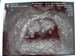 9 weeks ultrasound