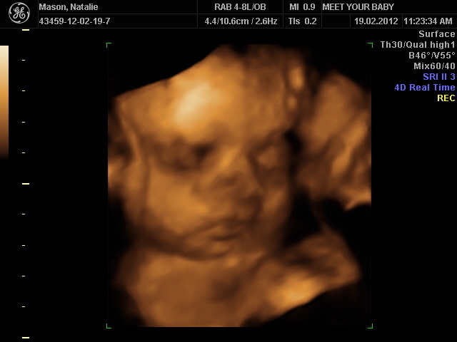 A 4D Photo of Max - Taken at 29 weeks gestation