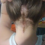 my incision, still crusty.. its not anymore though.. this is an old pic
