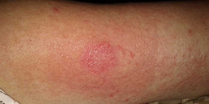 Rash and site injection/arm 3/22/12 (after 2 weeks)