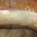 1day post op blue lines r markers for hardware