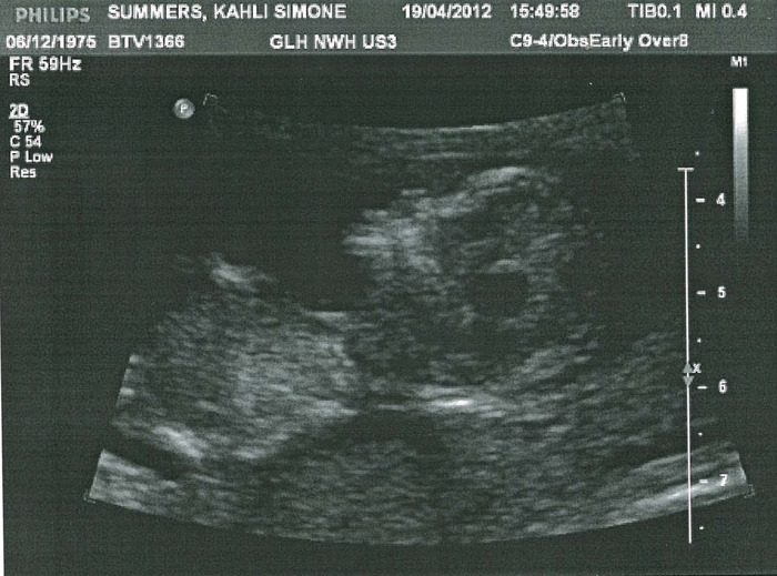 NT Scan - 12 weeks, 1 day