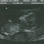 NT Scan - 12 weeks, 1 day