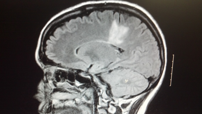 My MRI: Sagital Flair View