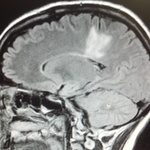 My MRI: Sagital Flair View