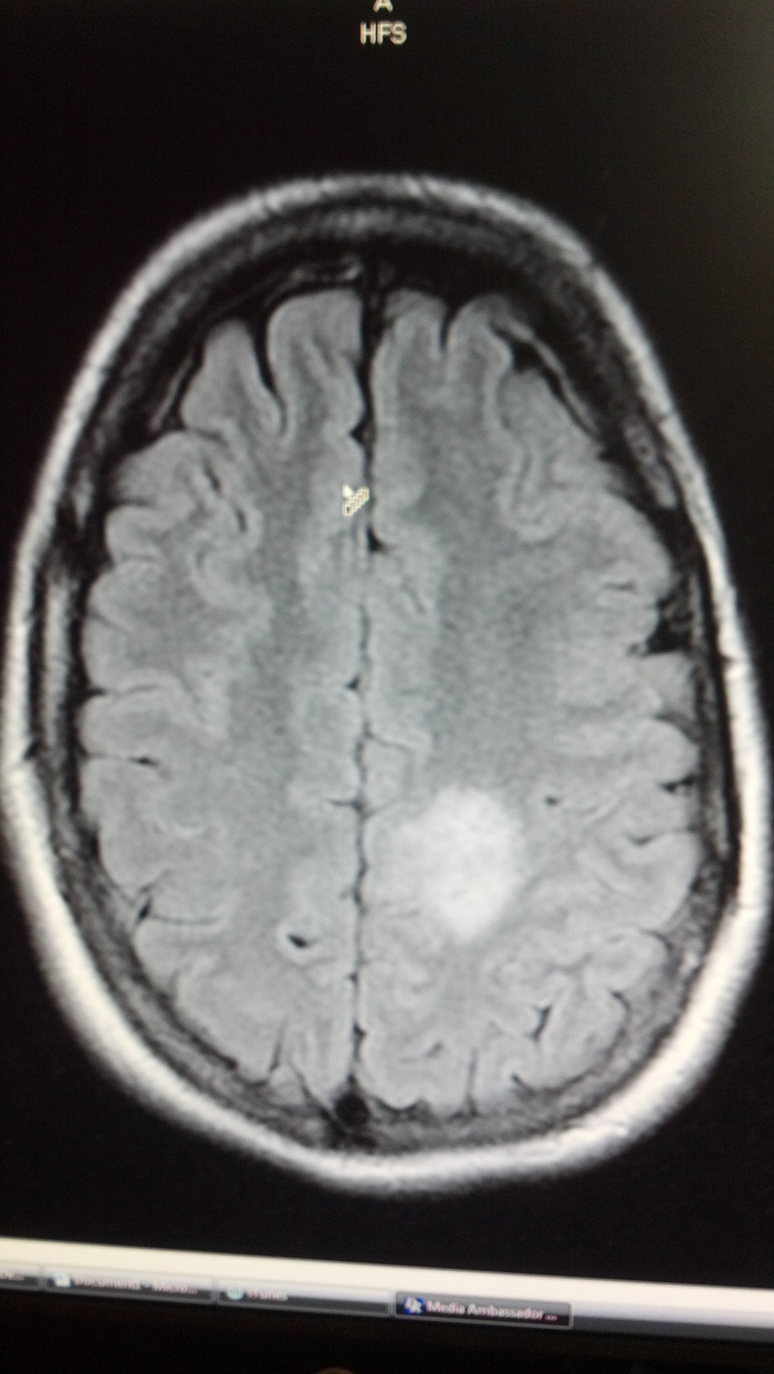 My MRI: 38mm lesion