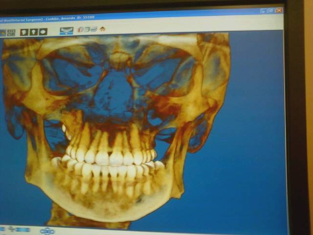 3D Image of my Skull